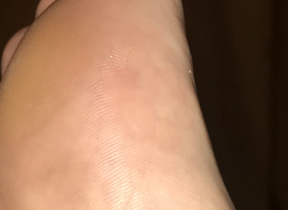 Ankle/Arches Pic