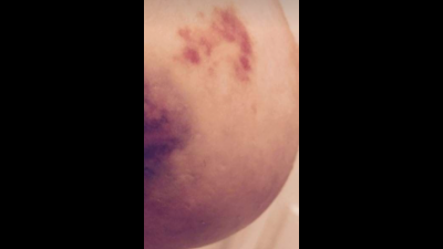 Big Titty Bruises
