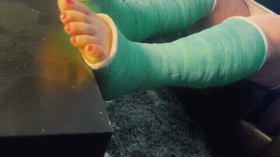 Dannie In Double Short Leg Casts Again