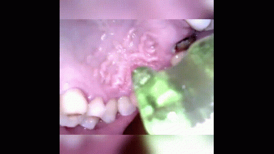 Reverse View Gummy Play