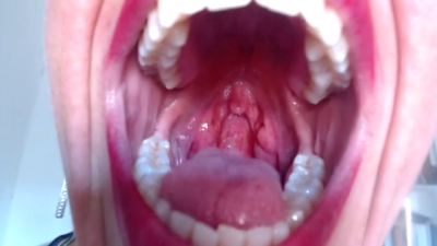 Flicking Uvula & Strong Gag Reflex
