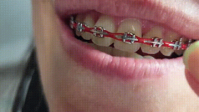 Braces And Mouth With Saliva Fetish