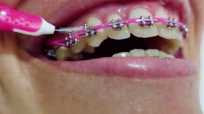 Cleaning My Pink Braces