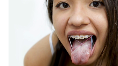 Braces + Rubber Bands Oral Sex Elastics Bands On Teeth 18Yo Blowjob