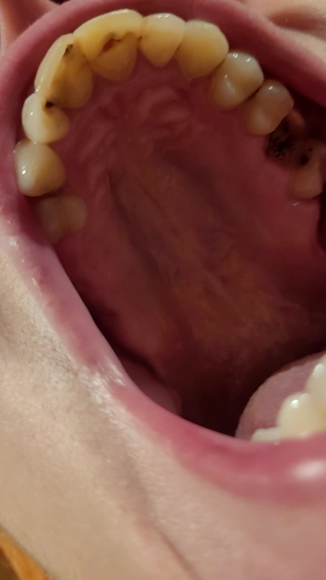 Showing Rotten Teeth And Tongue Before Brushing- Progress Of Missing Tooth(More Rotten)