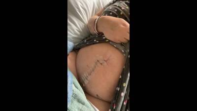 Fresh Scar Taking Up Half My Stomach