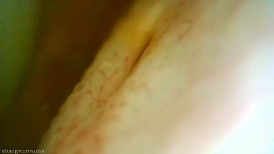 Ureter Releasing Piss Into Bladder