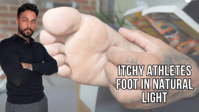 Itchy Athletes Foot In Natural Light Lalo Cortez