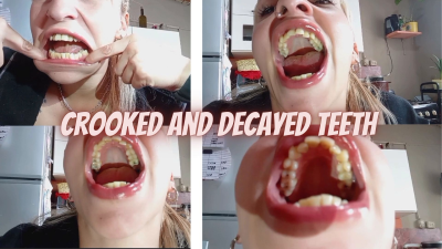 Examining My Mouth And Crooked Teeth
