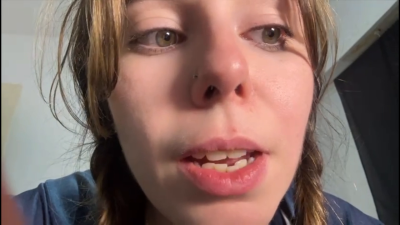 Showing You My Yellow Crooked Teeth, Bitting And Doing Weird Weird Faces