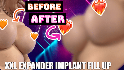 Xxl Expander Breast Implant Filling