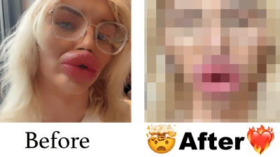Vienna Xtreme The Most Extreme Lip Injection
