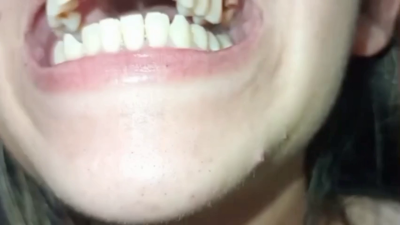 Lola's Defective Mouth