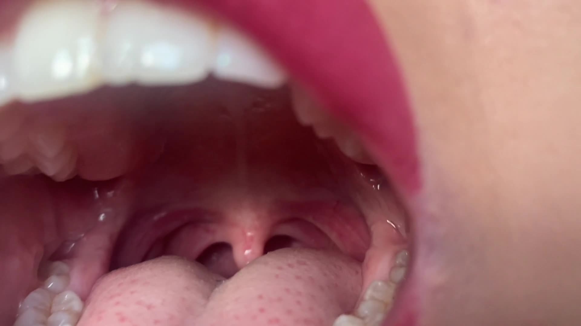 wide mouth uvula view