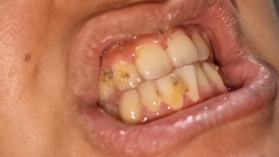 Dirty Mouth Cleaning