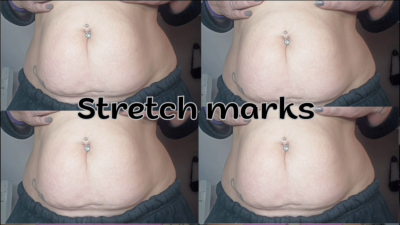 Stretch Marks Belly
