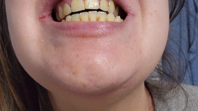 Cleaning My Dirty Croocked Teeth (Brushing Video)