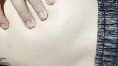 My Appendicitis Scar