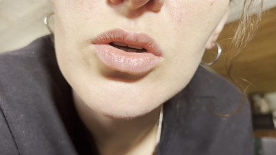 Decayed Teeth