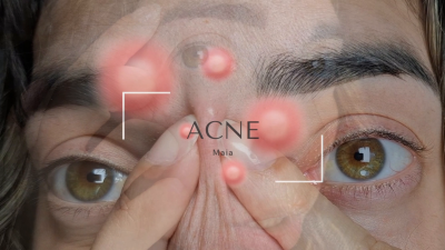 Acne Fetish