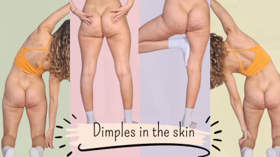 Dimples In The Skin