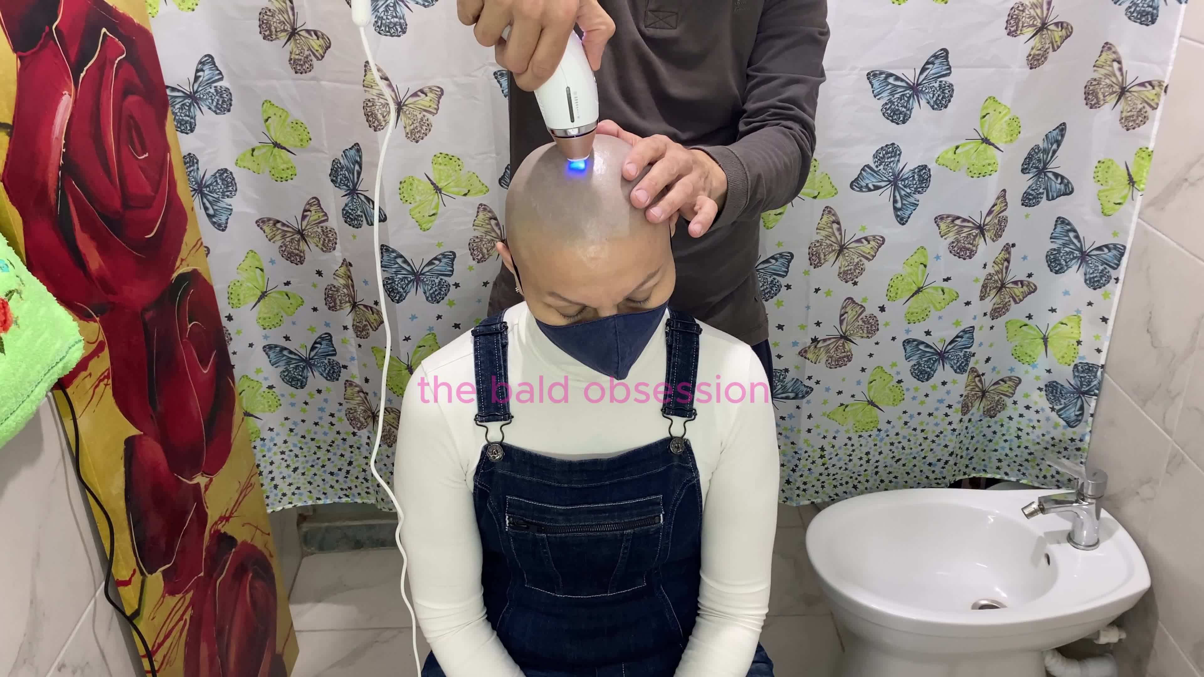 Ipl Hair Removal On Bald Head "Second Session"