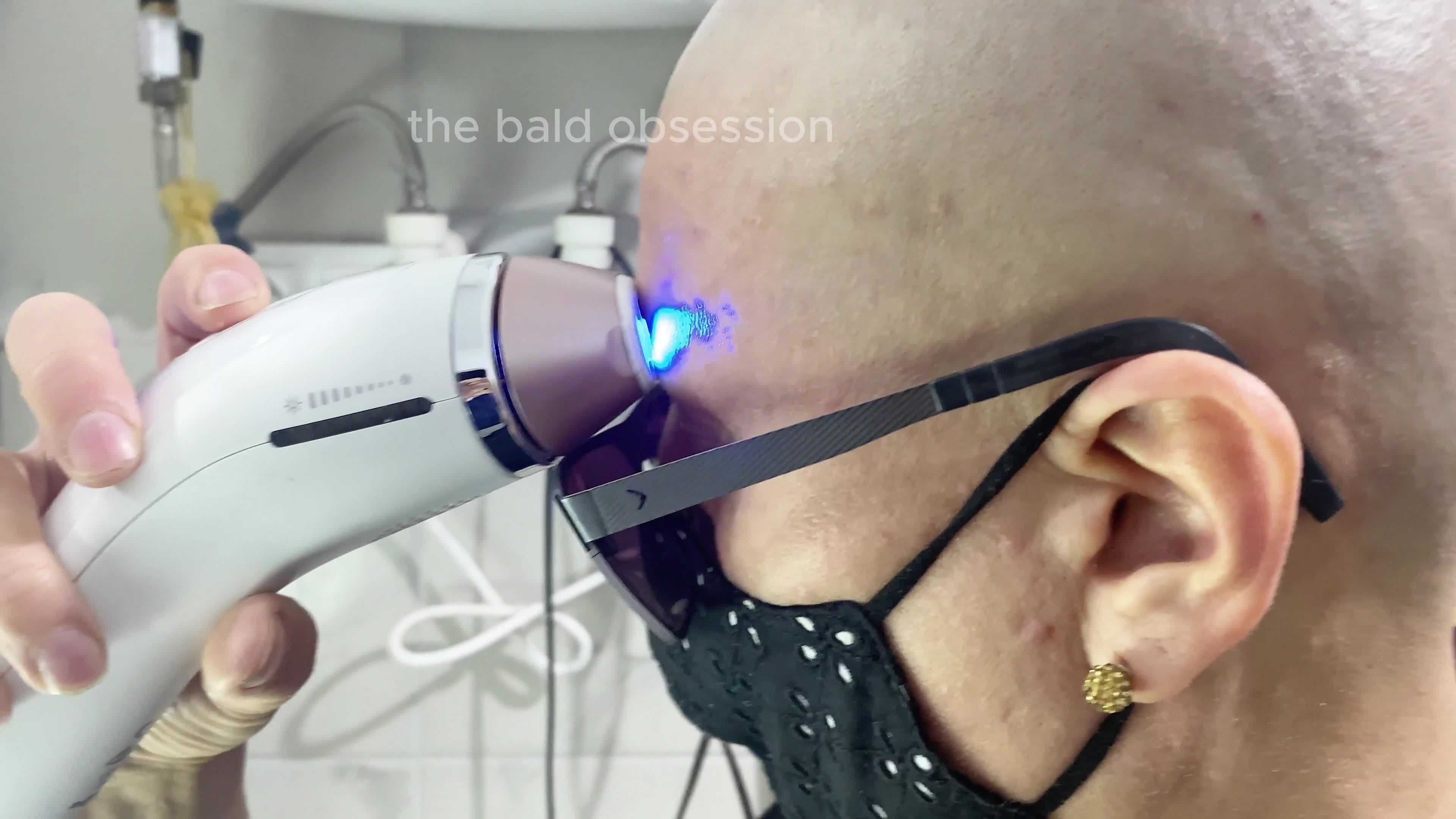 I'm Getting Ipl Treatment To Make My Head Even Smoother And Hair-Free