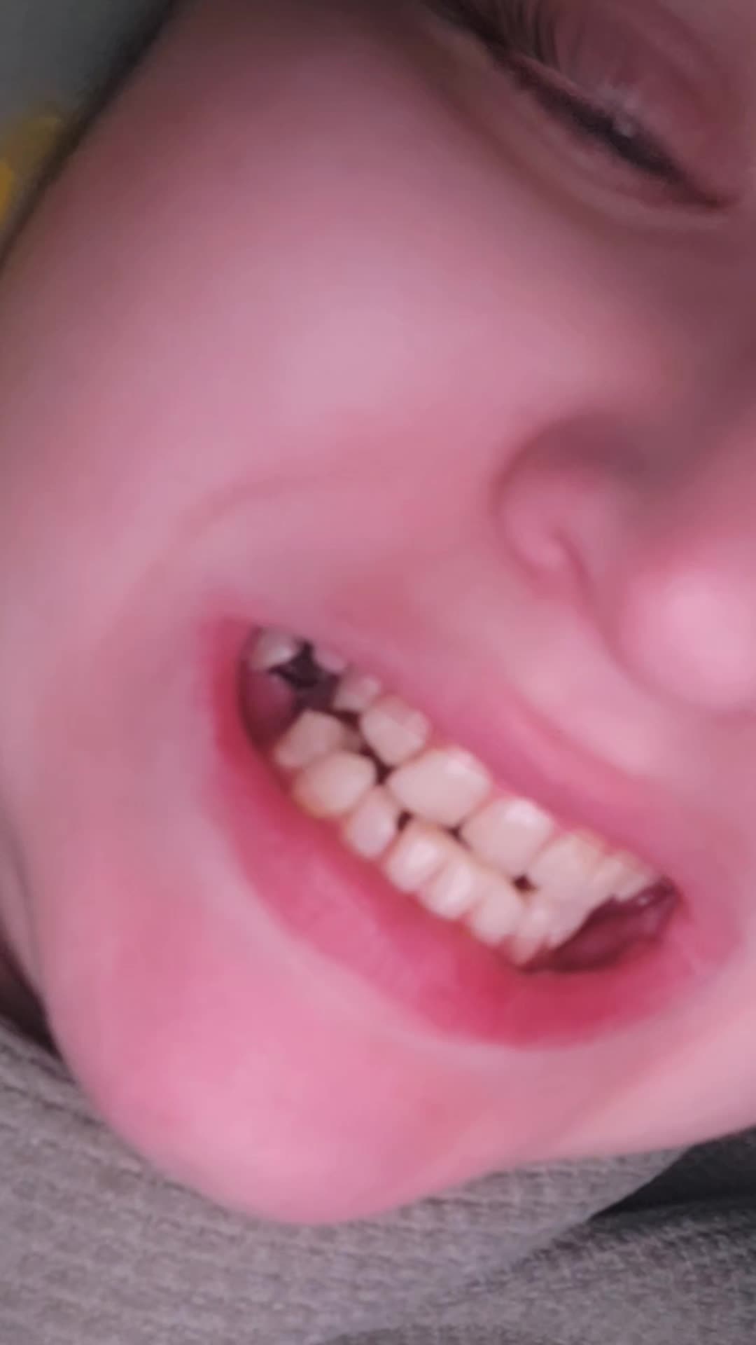 Two Cracked Fillings