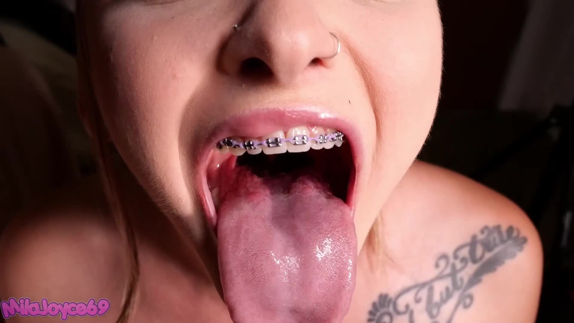 Braces Fetish