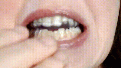 Mouth Gaurd And Tour