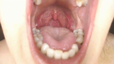 Throat And Mouth Spit Strings Uvula Tonsils Uvula