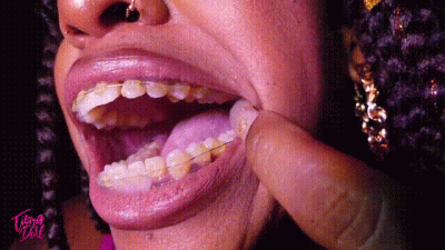 Braces Mouth Tour