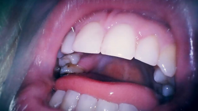 Mouth Tour Endoscope Day