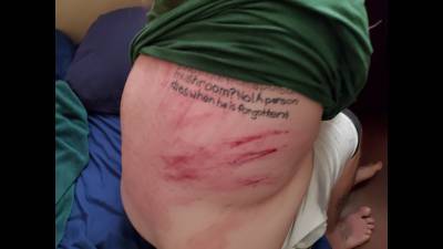 Dragon Tail Whip Bruising Up Client's Back