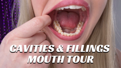 Cavities And Fillings Mouth Tour