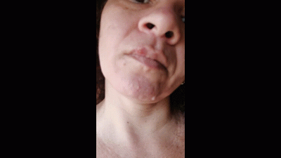 Herpes Labial